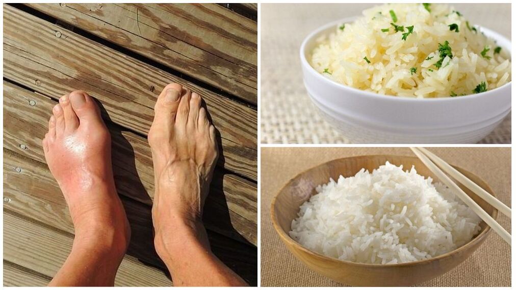 Un régime à base de riz est recommandé pour les personnes souffrant de goutte. 
